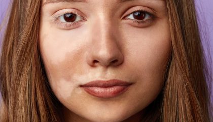 Cosmelan & Dermamelan Treatments for Hormonal Pigmentation