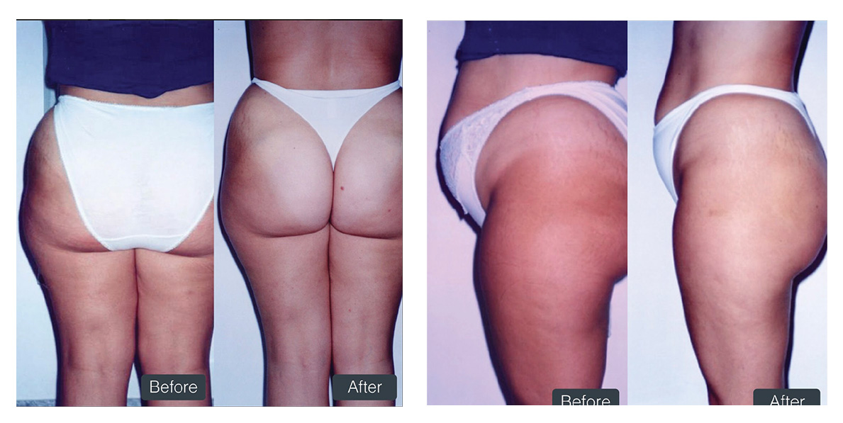 Fat Dissolving Injections in London Coley