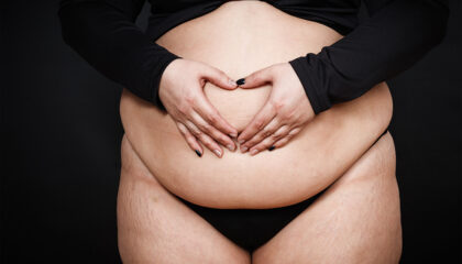 Full tummy tuck (abdominoplasty)