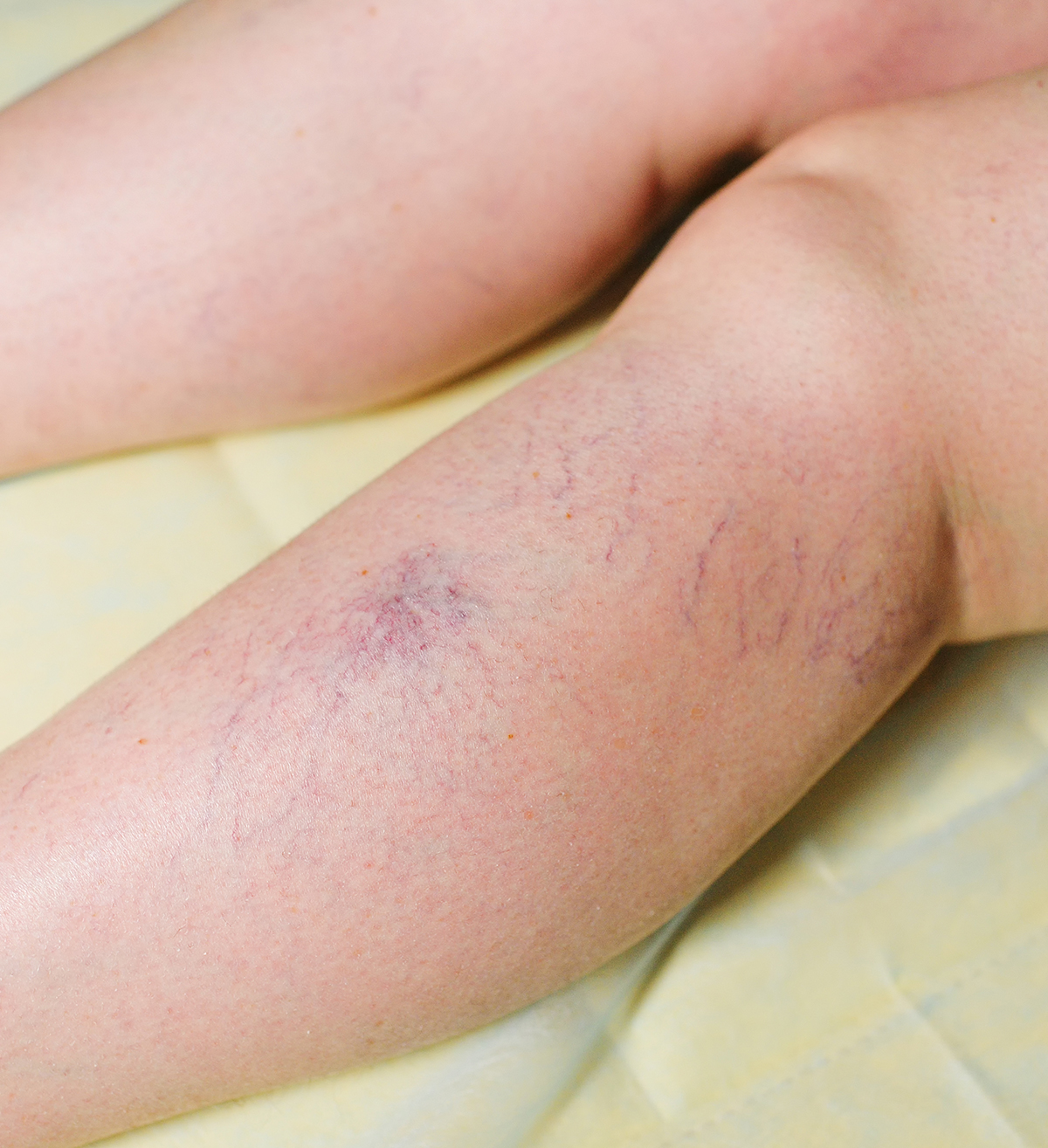 Microsclerotherapy Microsclerotherapy - Thread Vein Removal | Skin Medics UK